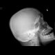 Fracture of the mandible: X-ray - Plain radiograph